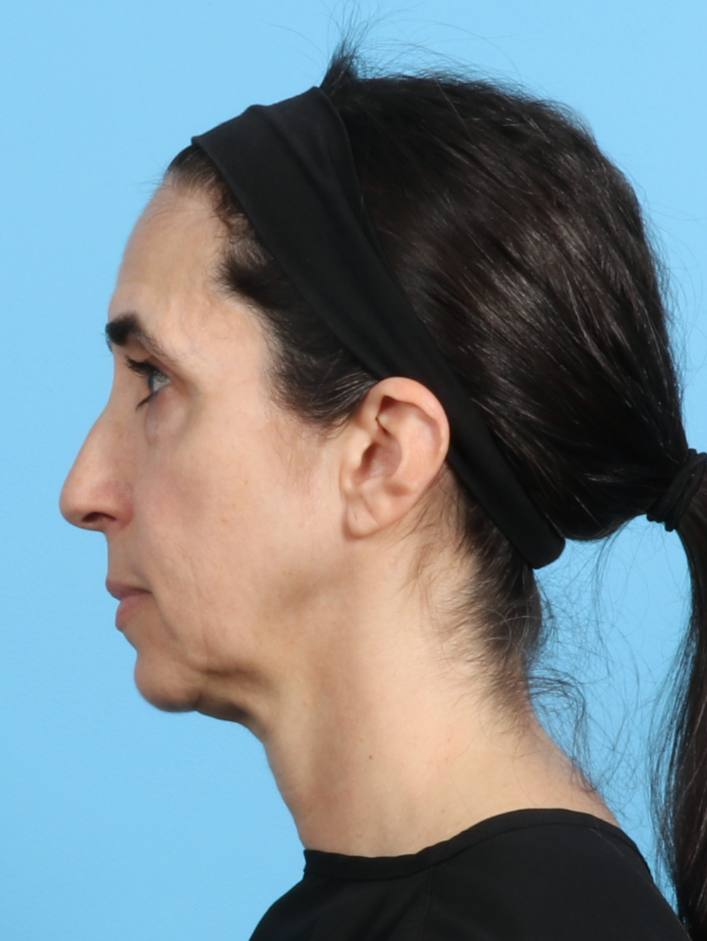 Eyelid Surgery Patient Photo - Case 2963 - before view-2