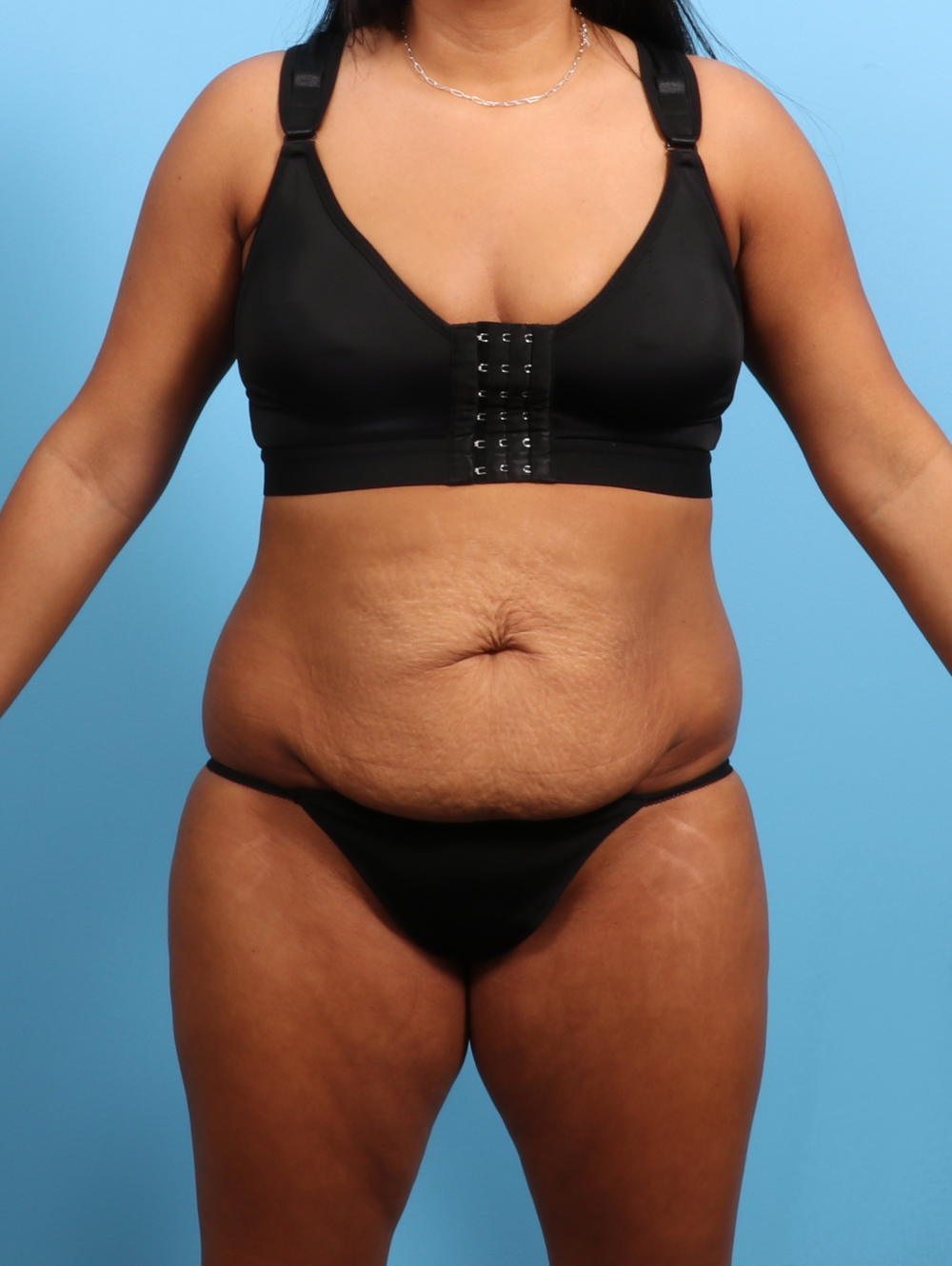 Tummy Tuck Patient Photo - Case 3026 - before view-0