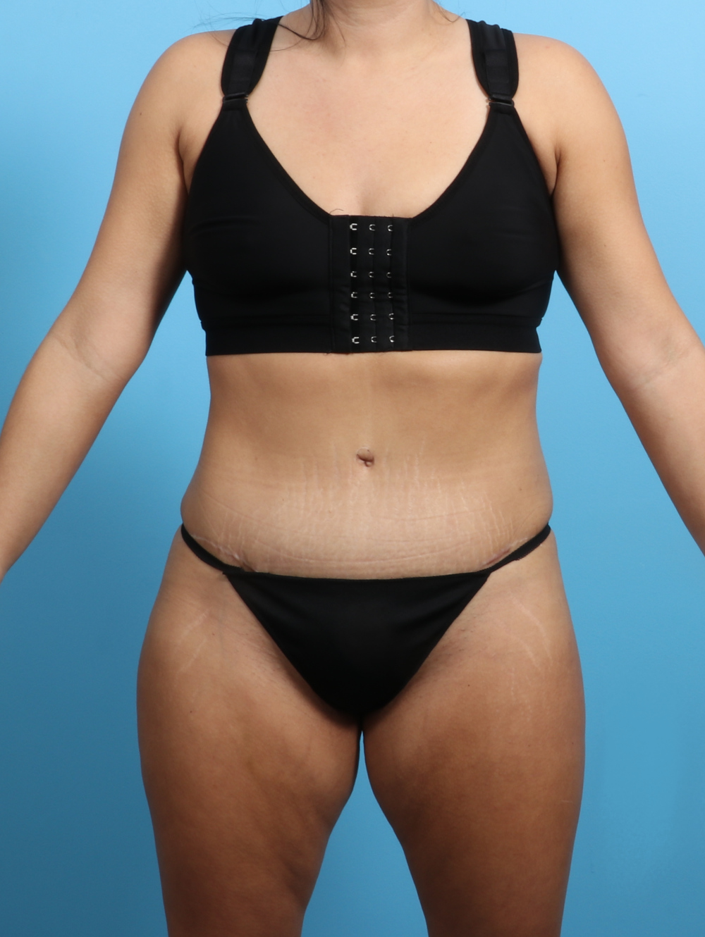 Tummy Tuck Patient Photo - Case 3026 - after view