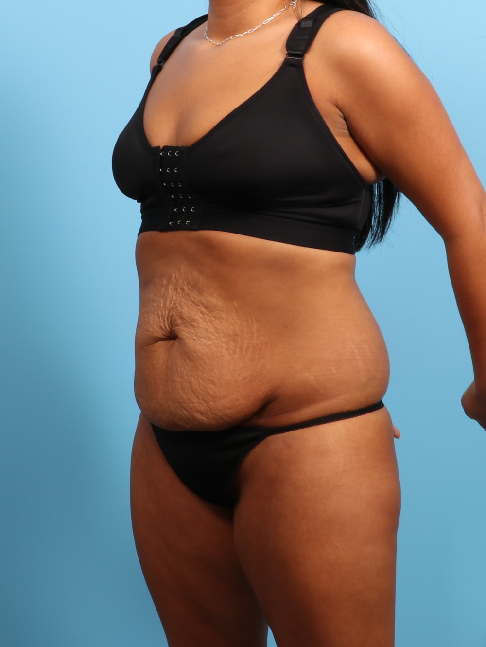Tummy Tuck Patient Photo - Case 3026 - before view-1
