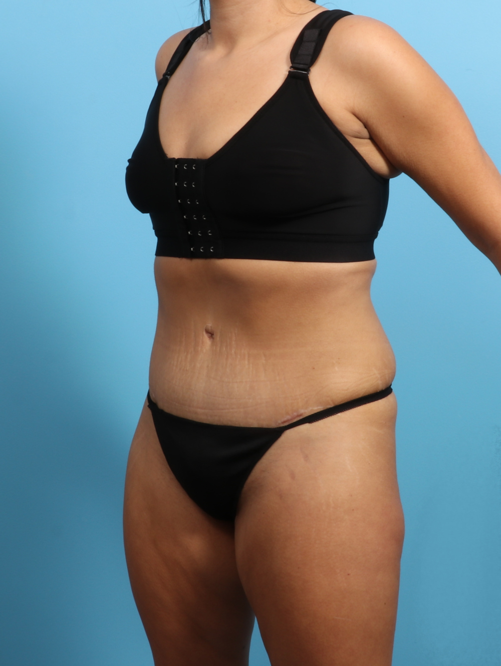 Tummy Tuck Patient Photo - Case 3026 - after view-1