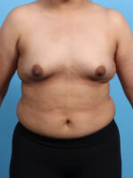 Breast Augmentation - Case 3203 - Before
