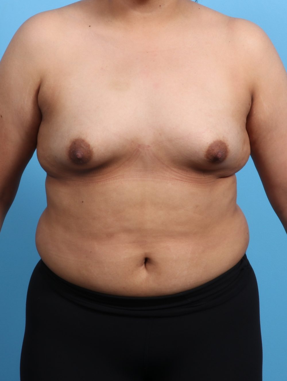 Breast Augmentation Patient Photo - Case 3203 - before view-0