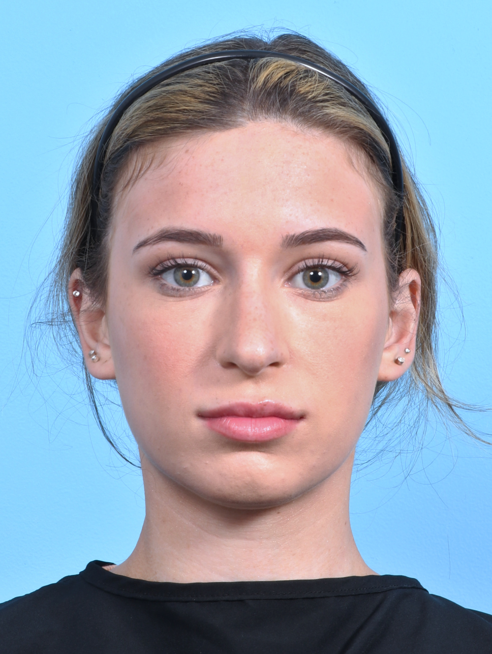Rhinoplasty Patient Photo - Case 3153 - before view-1