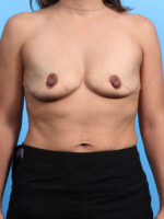 Breast Augmentation - Case 3185 - Before