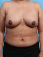 Breast Augmentation - Case 3203 - After