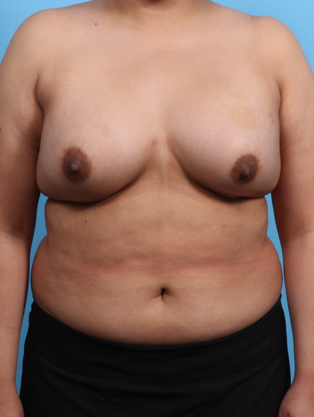 Breast Augmentation Patient Photo - Case 3203 - after view