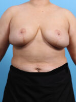 Breast Lift/Reduction - Case 3221 - After