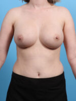 Breast Augmentation - Case 3129 - After