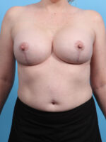 Breast Lift with Implants - Case 3169 - After