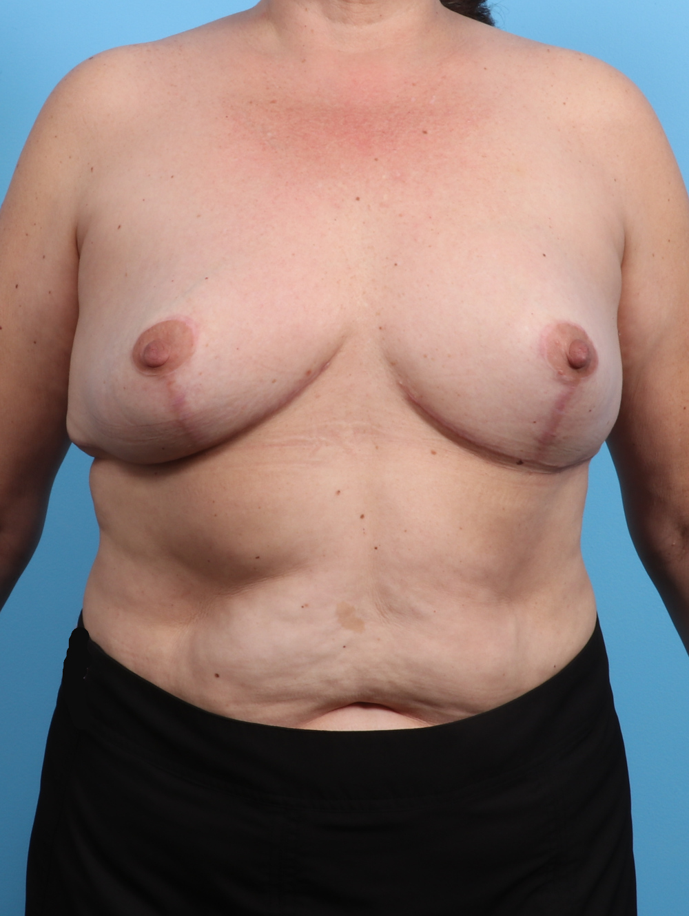 Breast Implant Revision Patient Photo - Case 3177 - after view