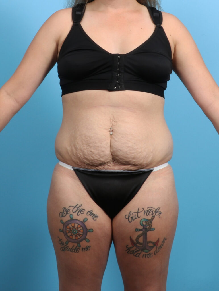 Liposuction - Case 3193 - Before