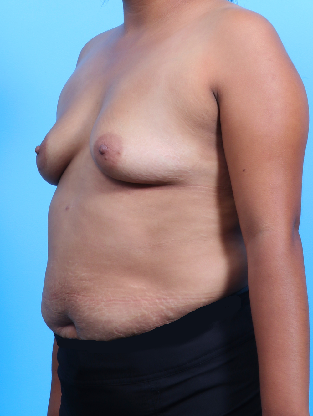 Breast Augmentation Patient Photo - Case 3112 - before view-1