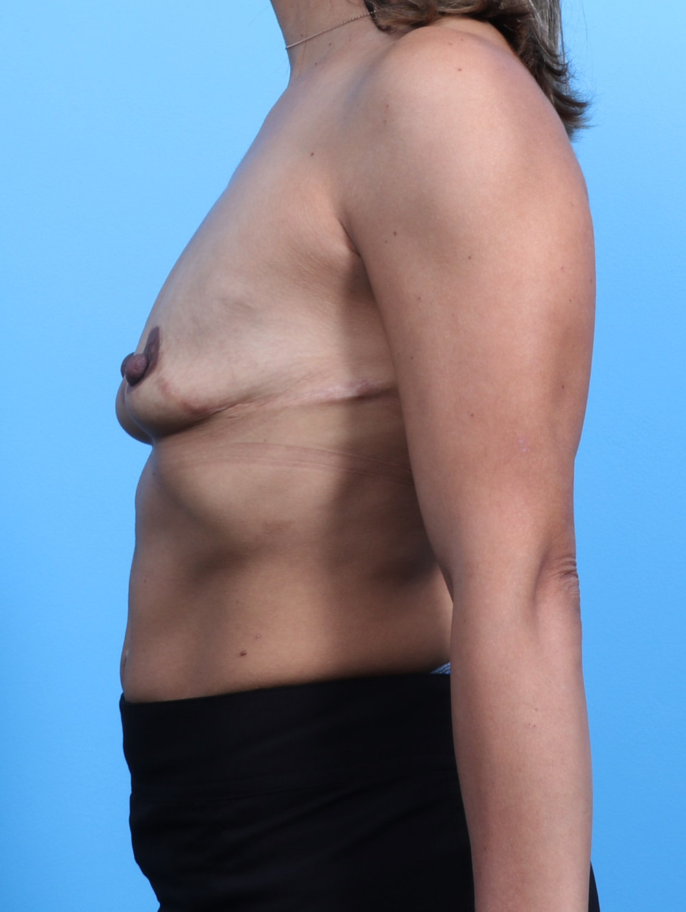 Breast Augmentation Patient Photo - Case 3185 - before view-2