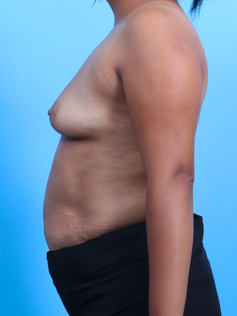 Breast Augmentation Patient Photo - Case 3112 - before view-2