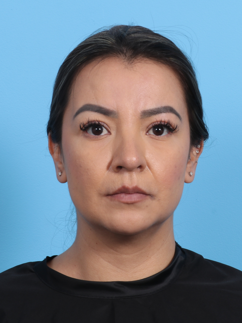 Rhinoplasty Patient Photo - Case 3279 - after view-1