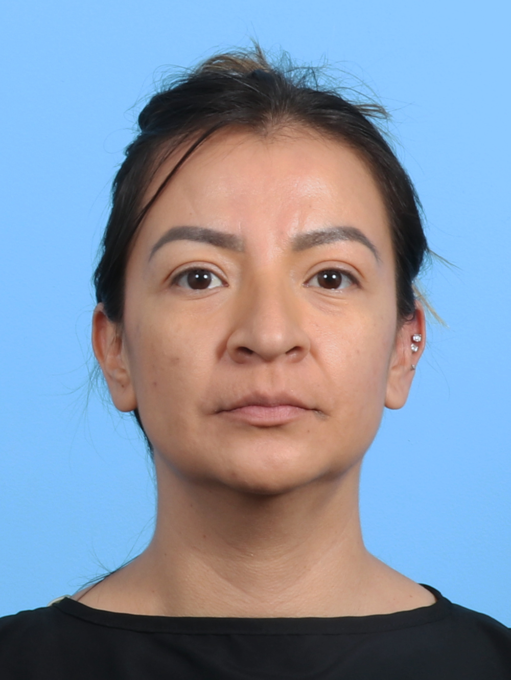 Rhinoplasty Patient Photo - Case 3279 - before view-1