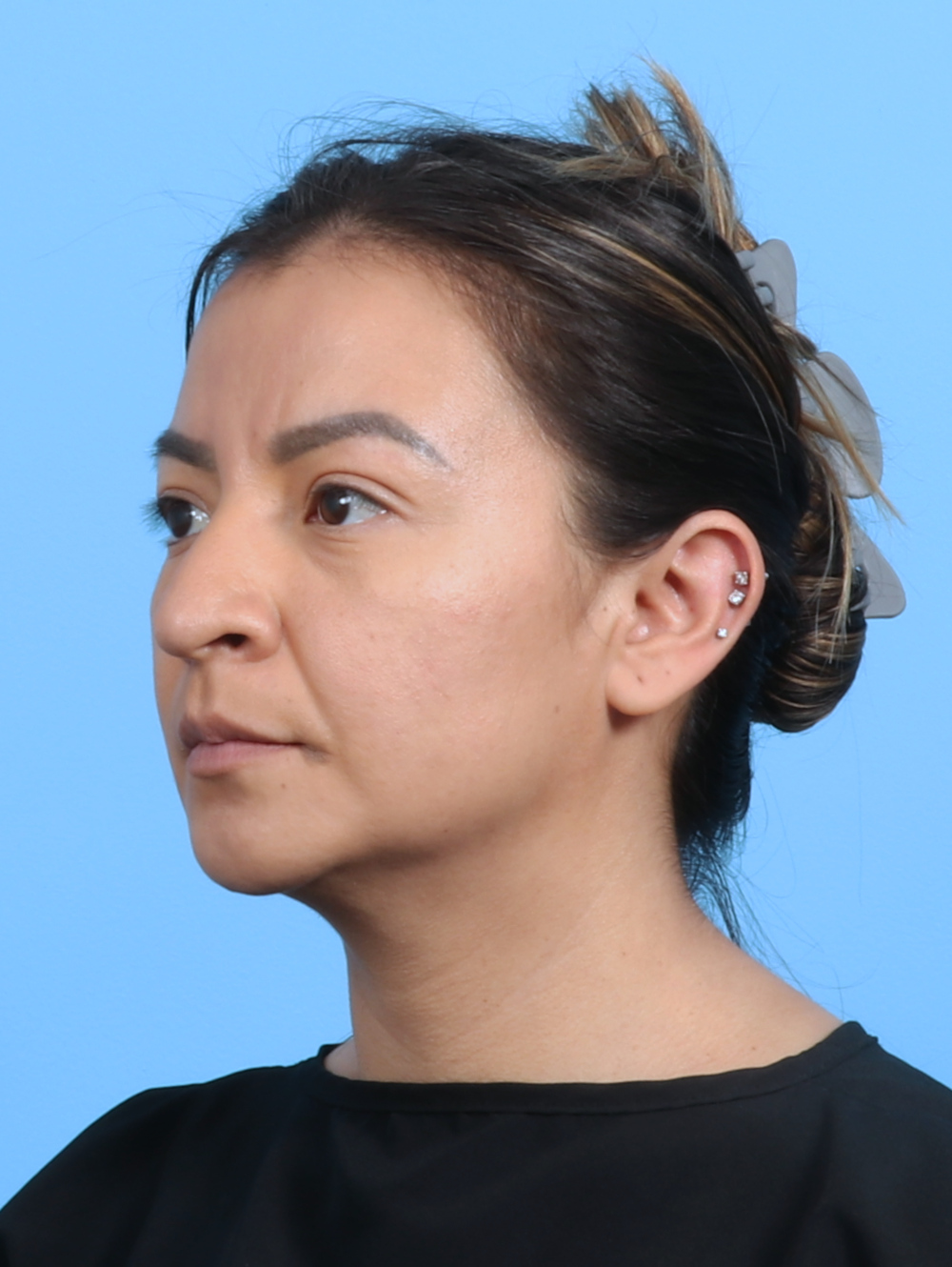 Rhinoplasty Patient Photo - Case 3279 - before view-2