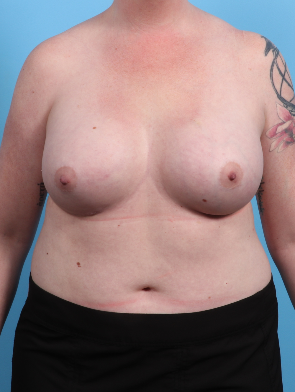 Breast Augmentation Patient Photo - Case 3287 - after view