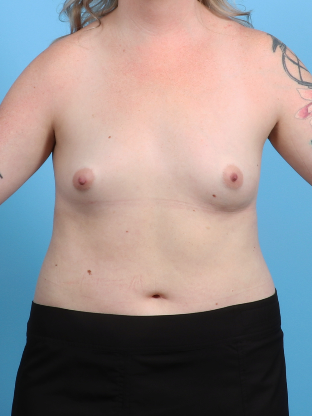 Breast Augmentation Patient Photo - Case 3287 - before view-