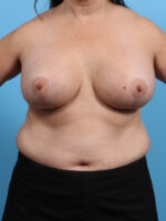 Breast Lift with Implants - Case 3303 - After