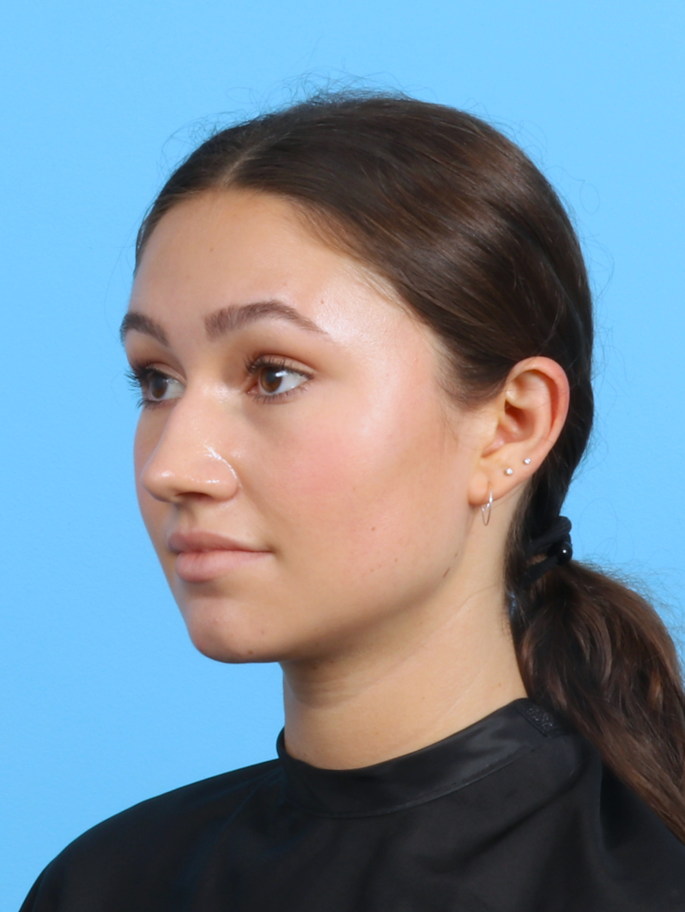 Rhinoplasty Patient Photo - Case 3311 - before view-2