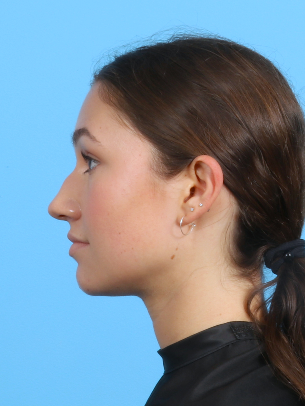 Rhinoplasty Patient Photo - Case 3311 - before view-