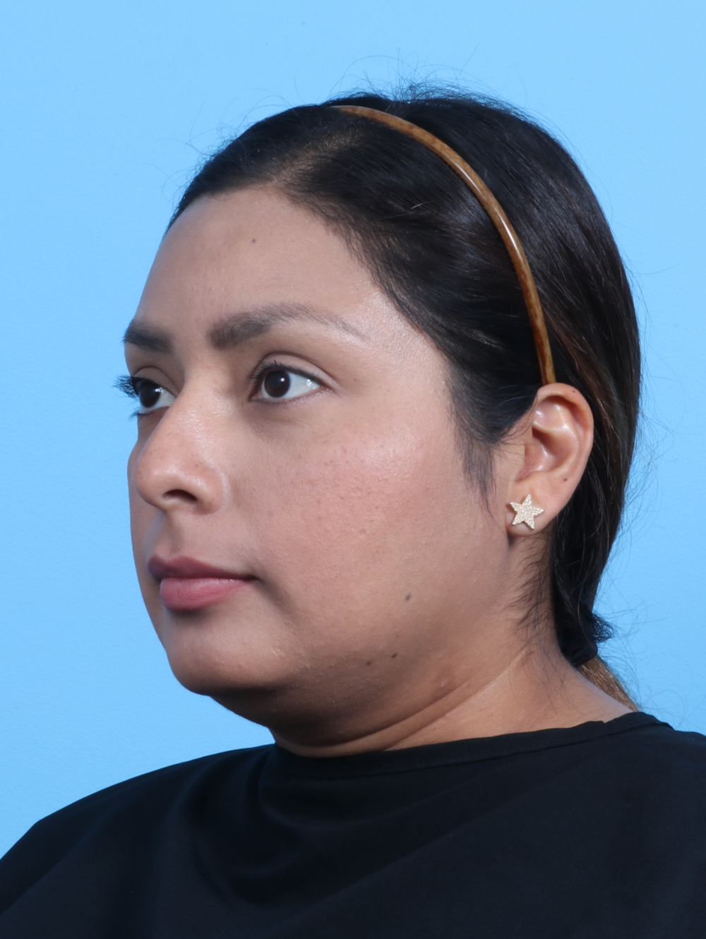 Rhinoplasty Patient Photo - Case 3319 - before view-2