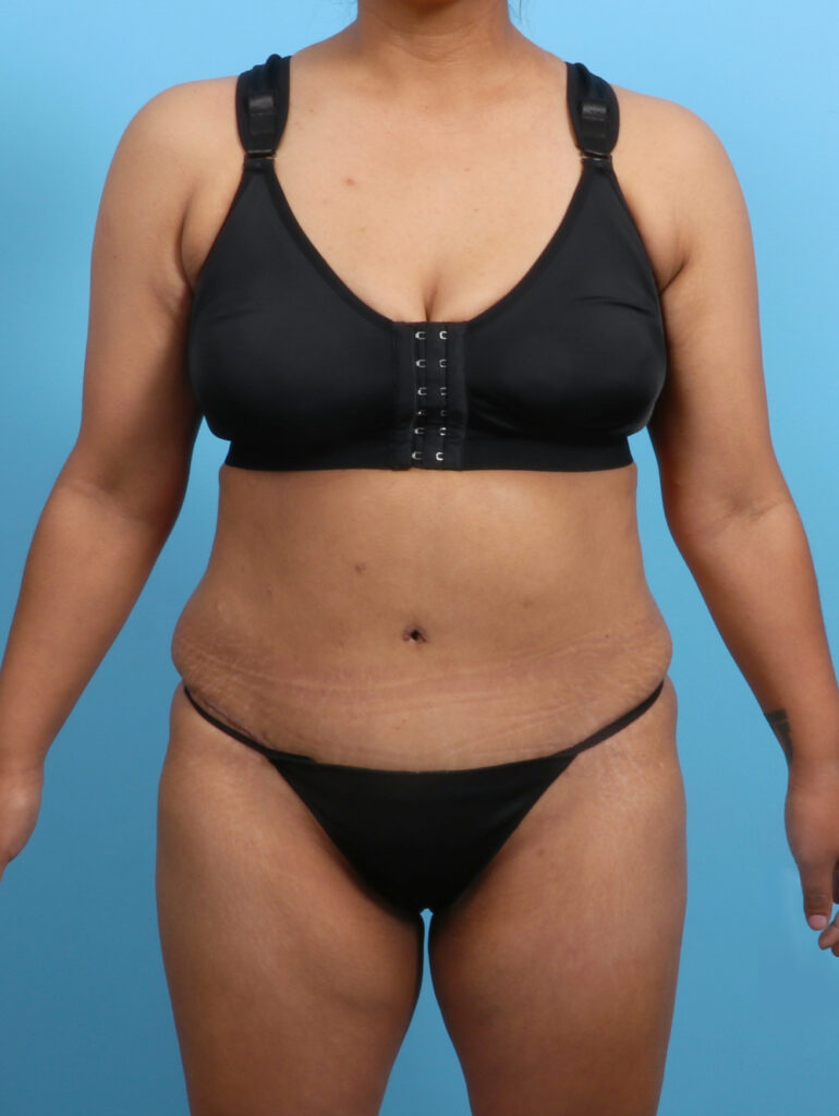 Tummy Tuck - Case 3327 - After