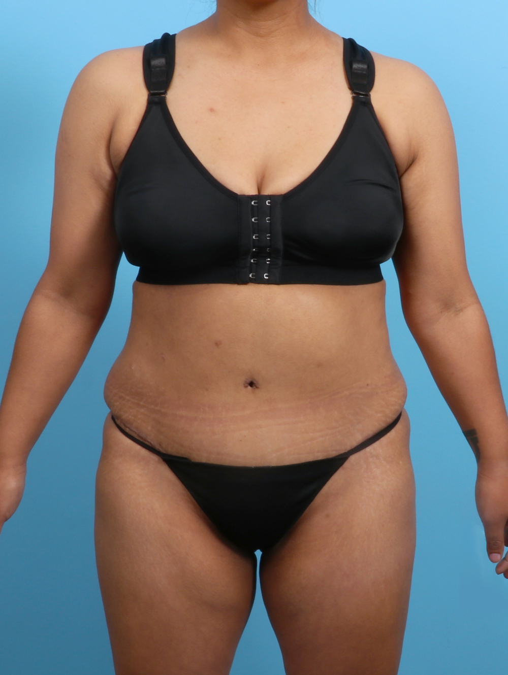 Tummy Tuck Patient Photo - Case 3327 - after view-0
