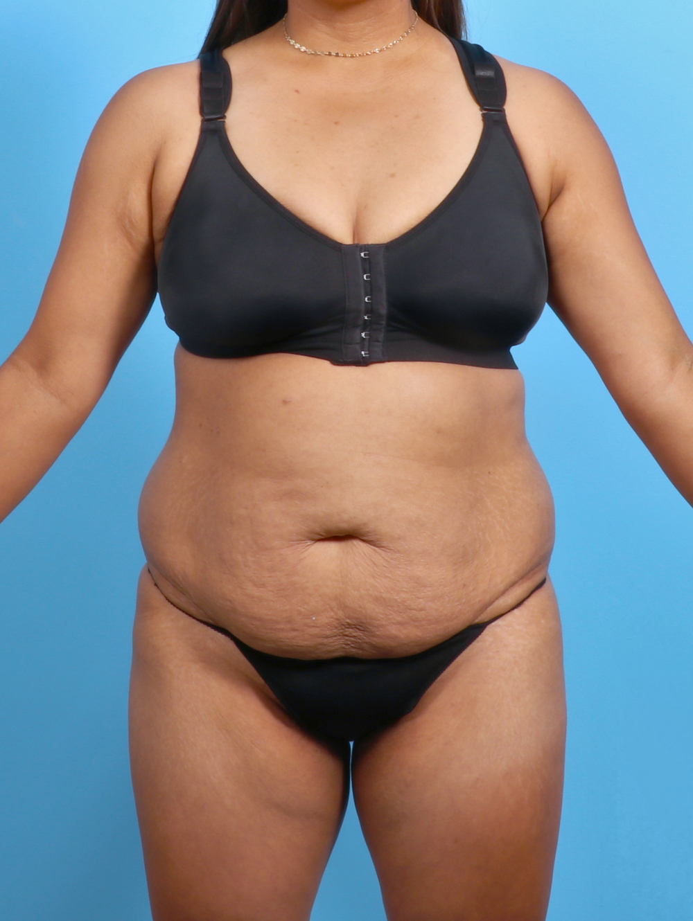 Tummy Tuck Patient Photo - Case 3327 - before view-