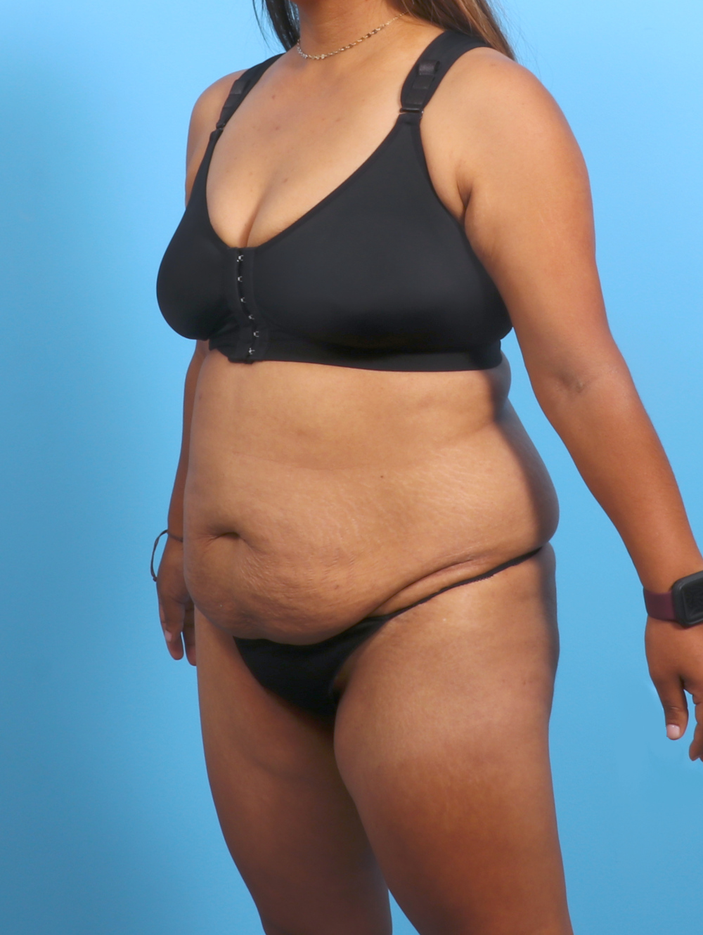 Tummy Tuck Patient Photo - Case 3327 - before view-1