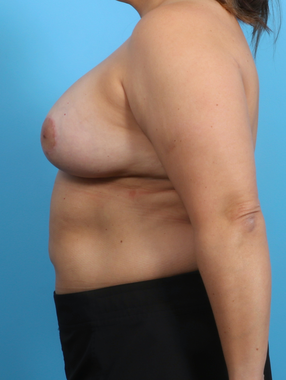 Breast Implant Revision Patient Photo - Case 3335 - after view-2