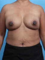 Breast Implant Revision - Case 3351 - After
