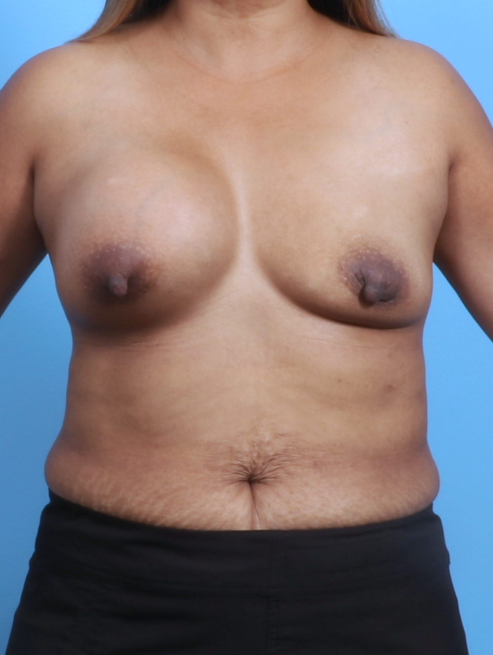 Breast Implant Revision Patient Photo - Case 3351 - before view-