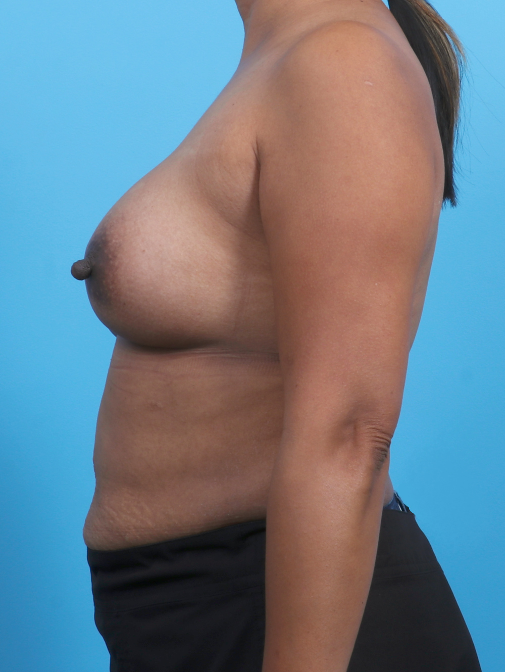 Breast Implant Revision Patient Photo - Case 3351 - after view-2