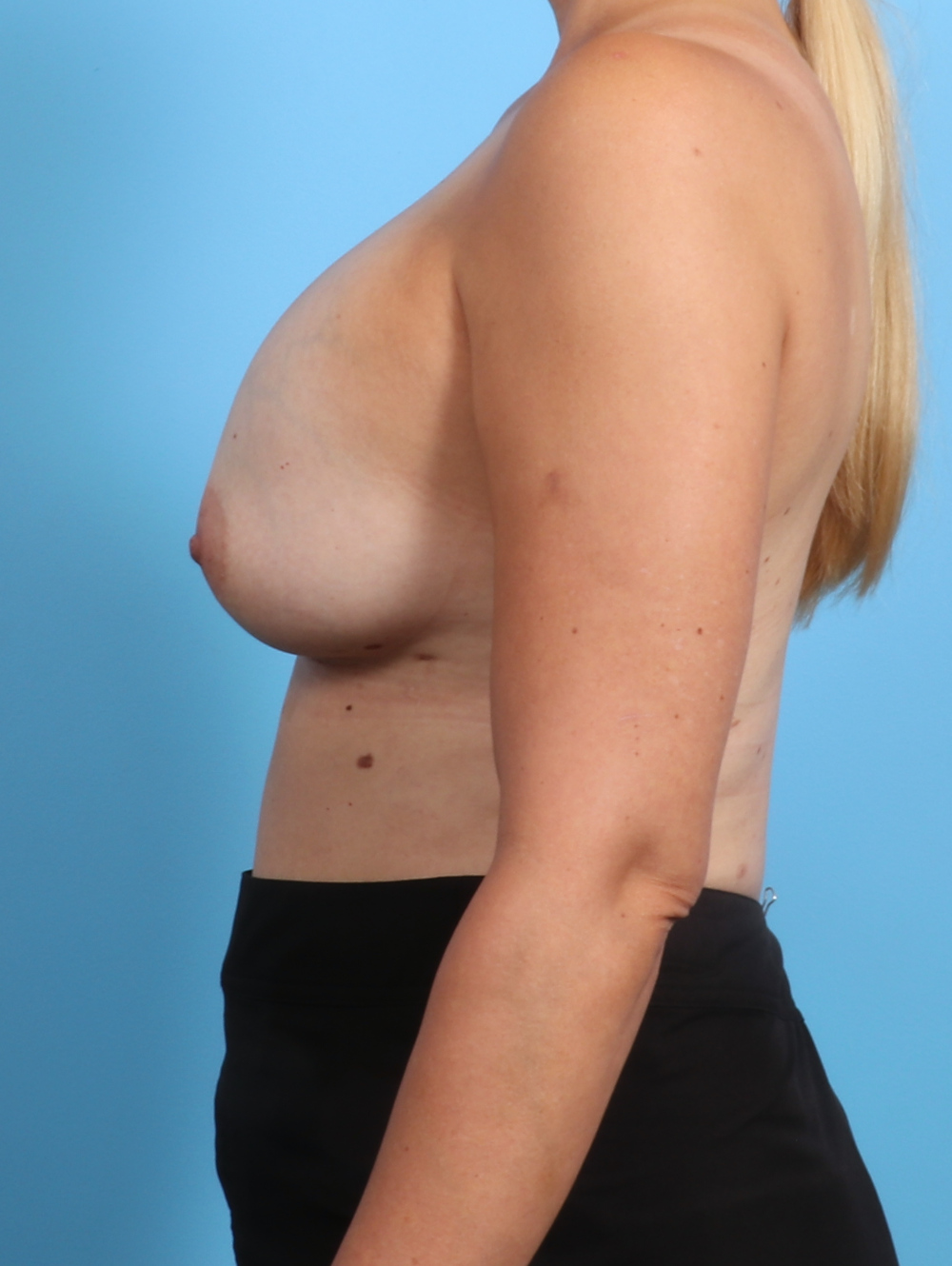 Breast Implant Revision Patient Photo - Case 3359 - before view-2