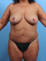 Tummy Tuck - Case 3407 - After