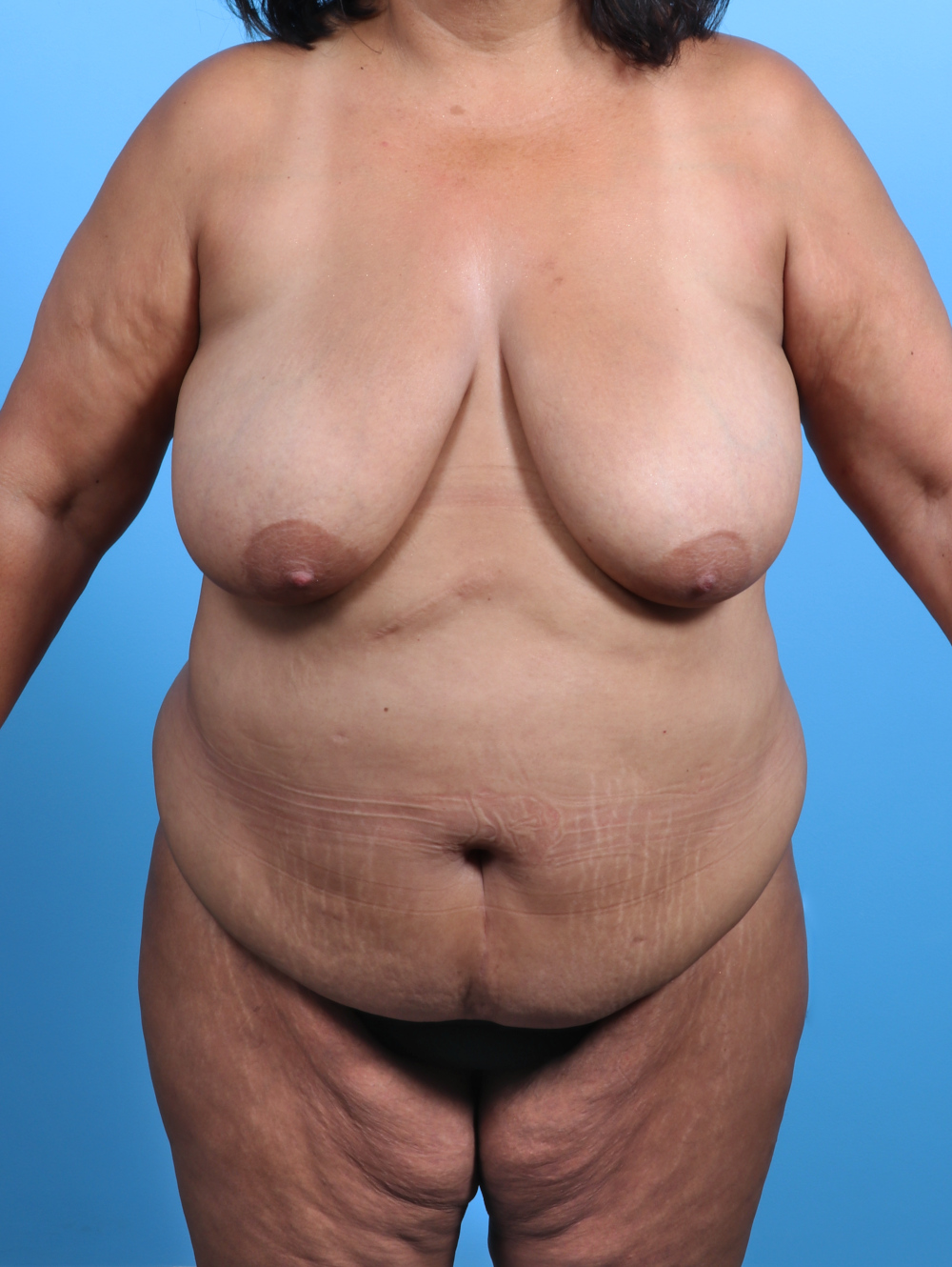 Tummy Tuck Patient Photo - Case 3407 - before view-