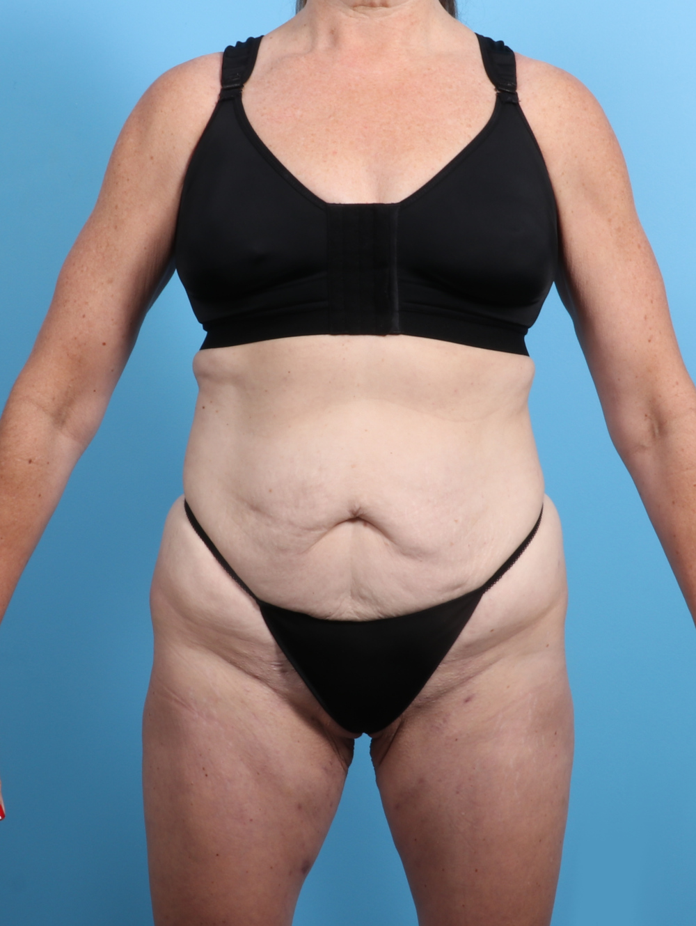 Tummy Tuck Patient Photo - Case 3415 - before view-0