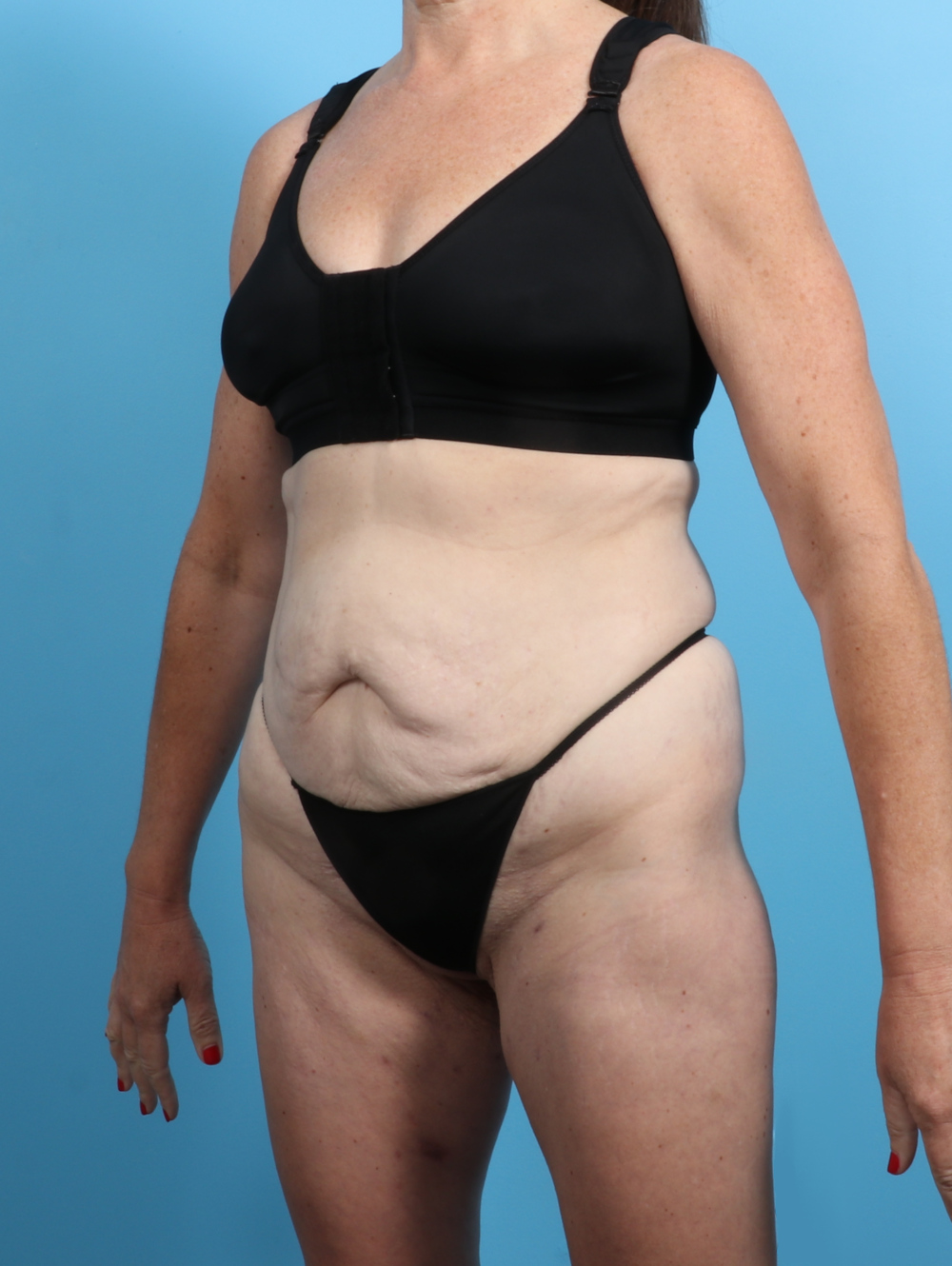 Tummy Tuck Patient Photo - Case 3415 - before view-1