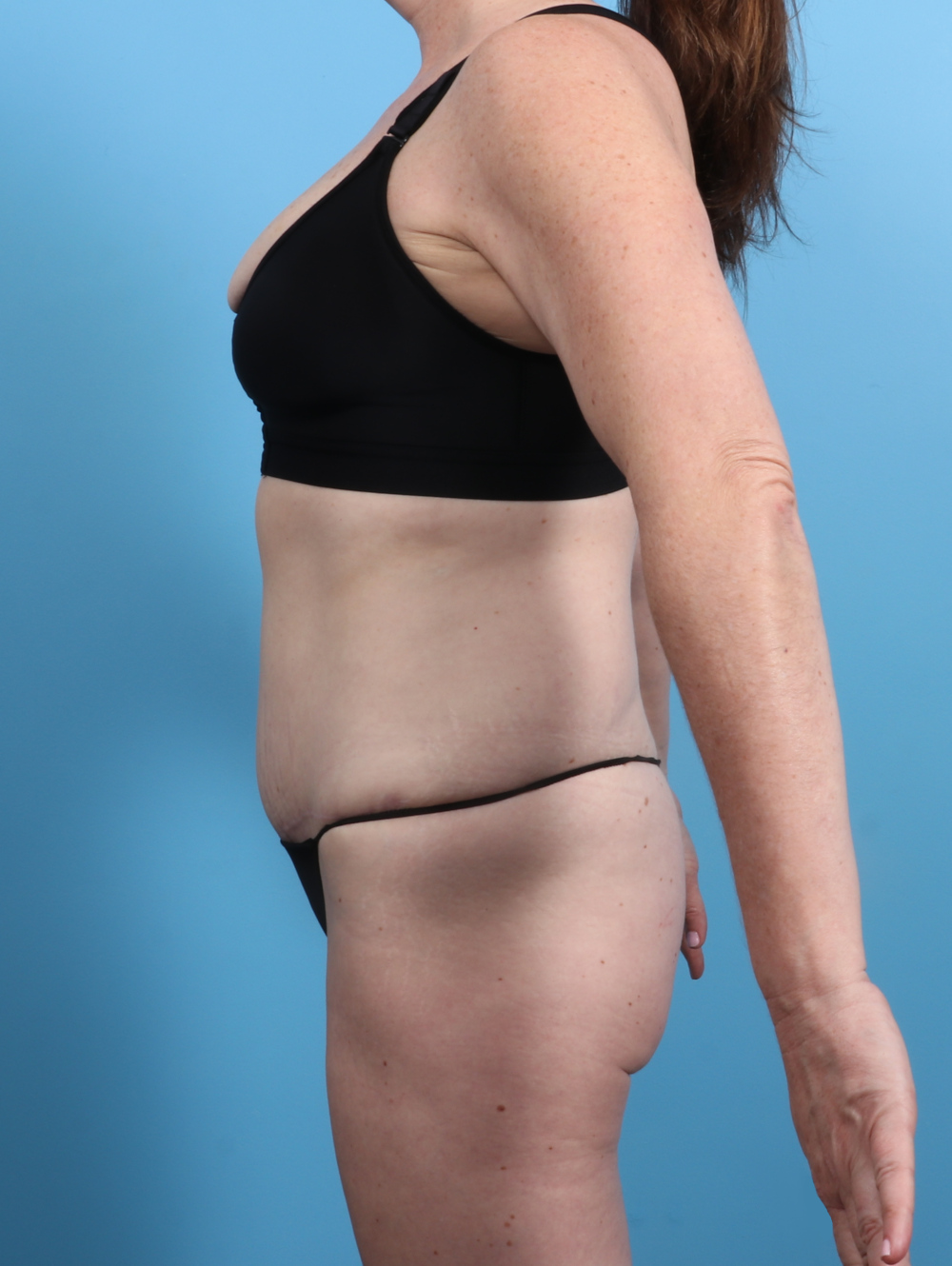 Tummy Tuck Patient Photo - Case 3415 - after view-2