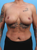 Breast Lift/Reduction - Case 3444 - After