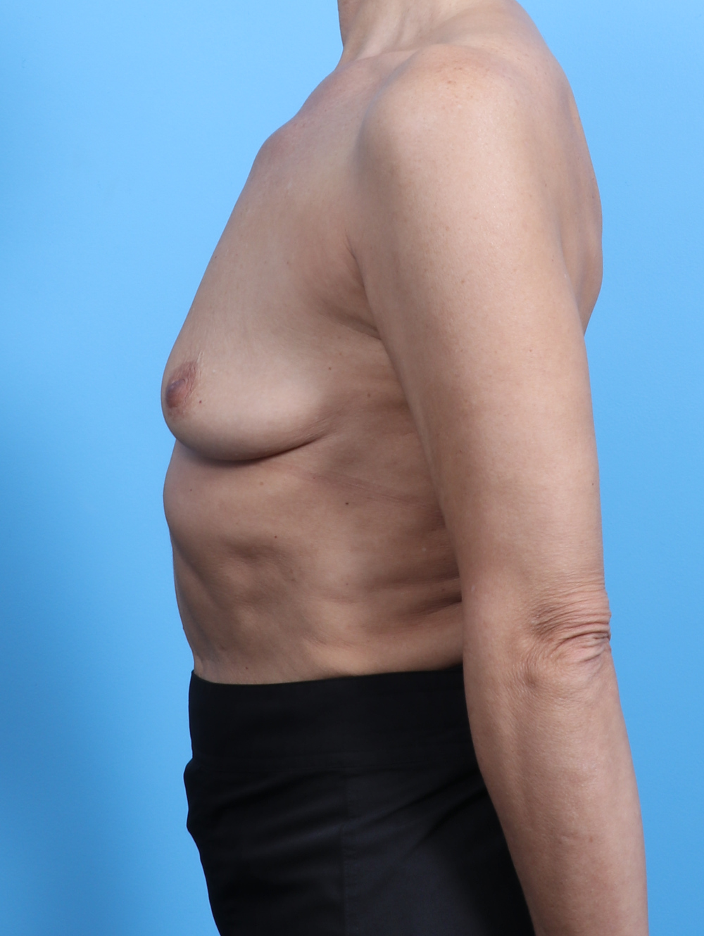 Breast Augmentation Patient Photo - Case 3452 - before view-2