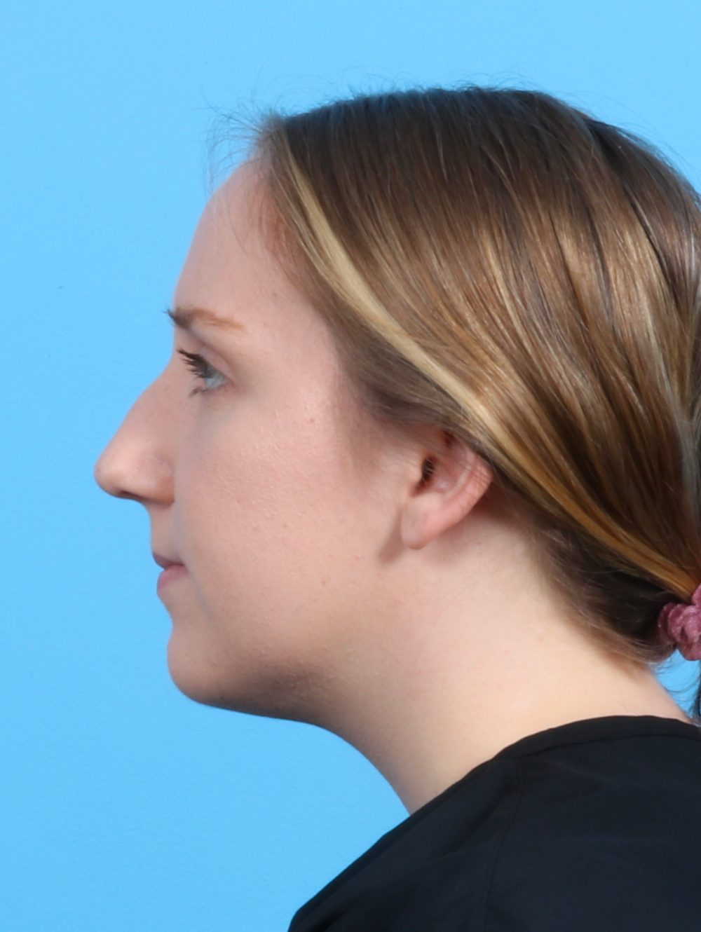 Rhinoplasty Patient Photo - Case 3486 - before view-