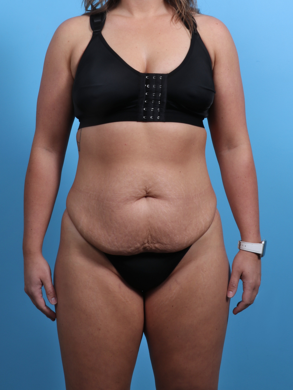 Tummy Tuck Patient Photo - Case 3510 - before view-