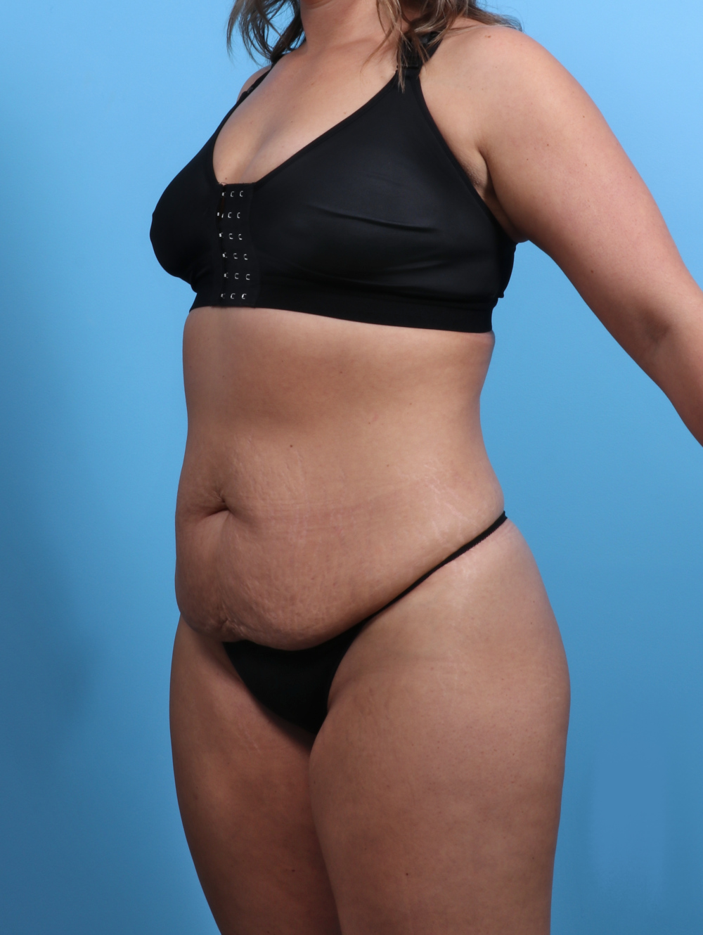 Tummy Tuck Patient Photo - Case 3510 - before view-1