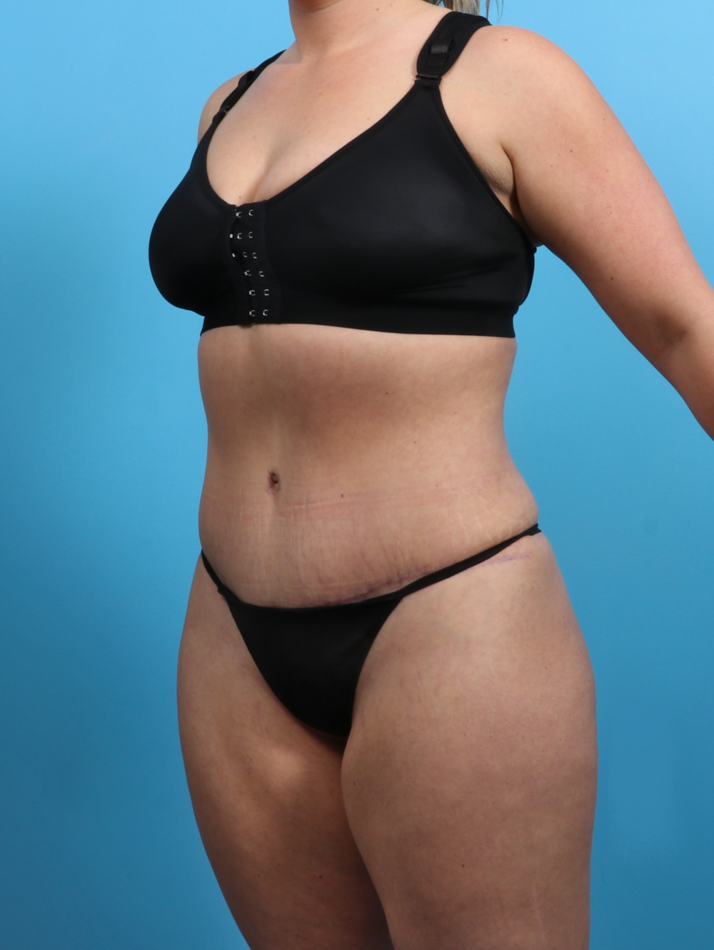 Tummy Tuck Patient Photo - Case 3510 - after view-1