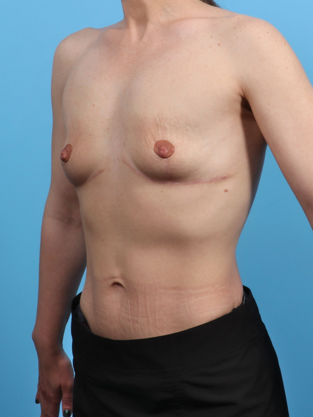 Breast Implant Revision Patient Photo - Case 3526 - after view-1