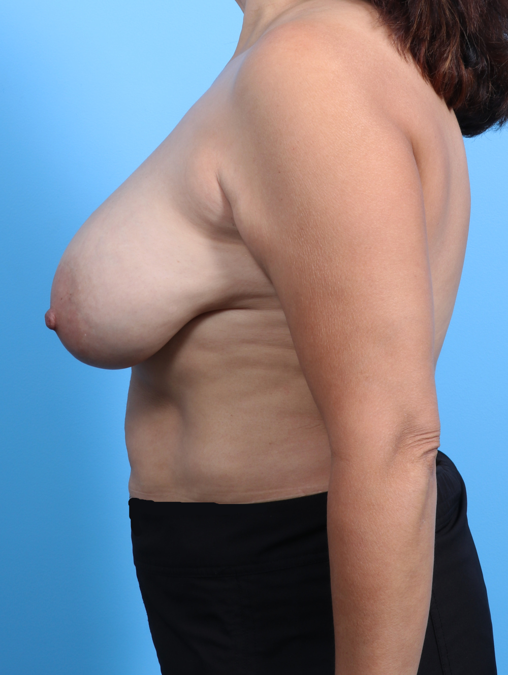 Breast Implant Revision Patient Photo - Case 3546 - before view-2